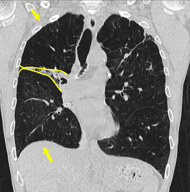 This image shows a lung with COPD after the placement of endobronchial valves to reduce hyperinflation.